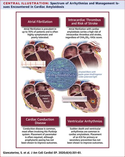 electrophysiology arrhythmia near belmont|Clinical Electrophysiology Section .